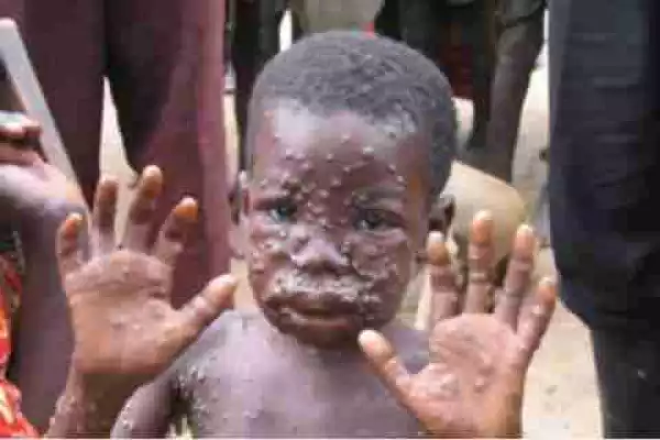Oh No: Panic as Bayelsa State Records 5 Confirmed Cases Of Monkeypox